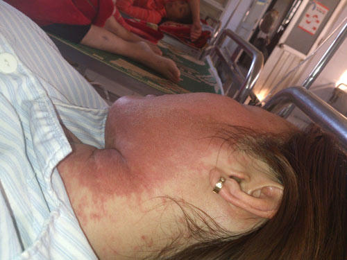 Nhập viện trong đêm tân hôn vì dị ứng..mỹ phẩm